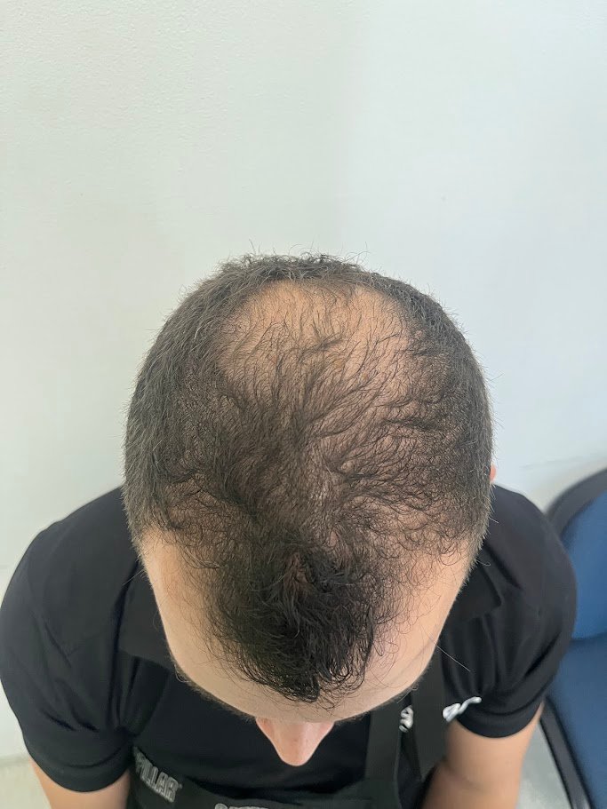 Cuero cabelludo de Juan Pérez antes del tratamiento